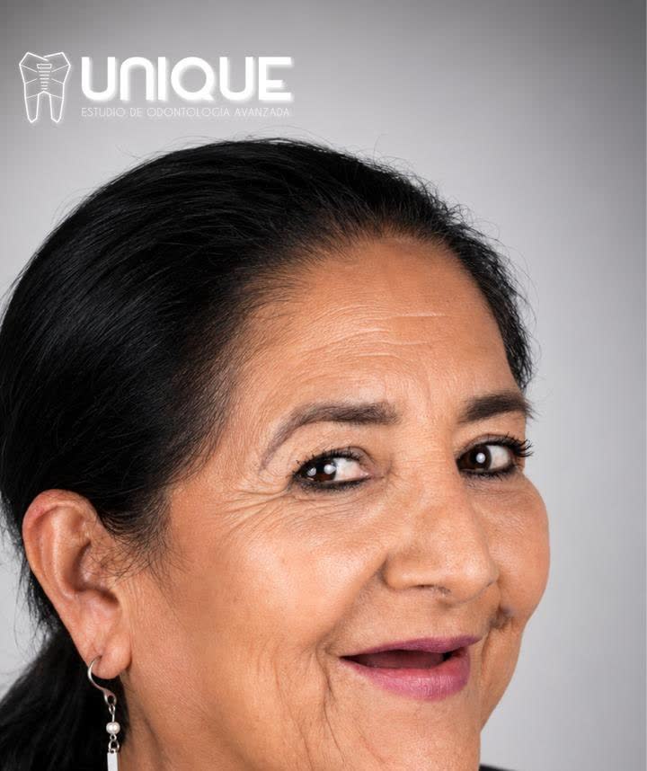Antes del tratamiento